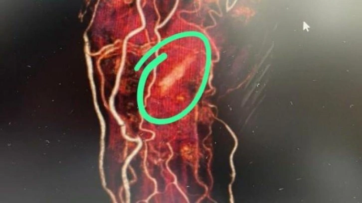 Hastanın eli içinde odun parçası unutuldu