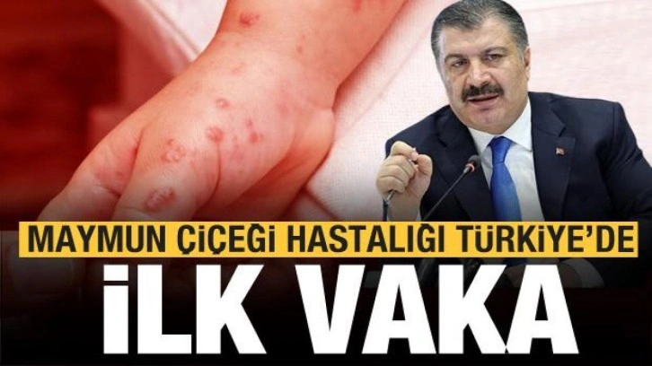 Türkiye'de ilk Maymun Çiçeği vakası tespit edildi! Bakan Koca'dan açıklama