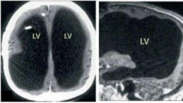 30 sene yarım beyinle yaşadığı ortaya çıktı