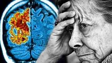 Alzheimer'ı teşhis eden kan testi geliştirildi