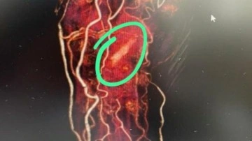 Hastanın eli içinde odun parçası unutuldu
