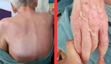 Huzurevinde sır ölüm: Dermatolojik hastalık tespit edilmedi!