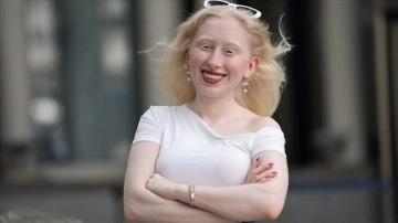 Sosyal medyanın pigmentsiz fenomeni paylaşımlarıyla albinoların sesi oluyor