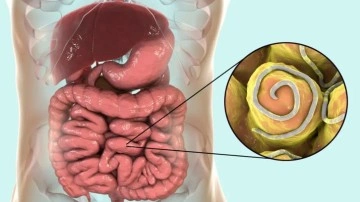 Yetişkinlerde kıl kurdu belirtileri: Kıl kurdu nasıl dökülür?